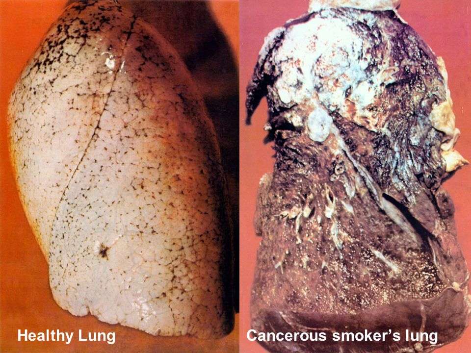 Levy Specific Tax on Tobacco Products To Improve Fiscal and Public Health- Study 2 HealthyLungCanceroussmokerslung