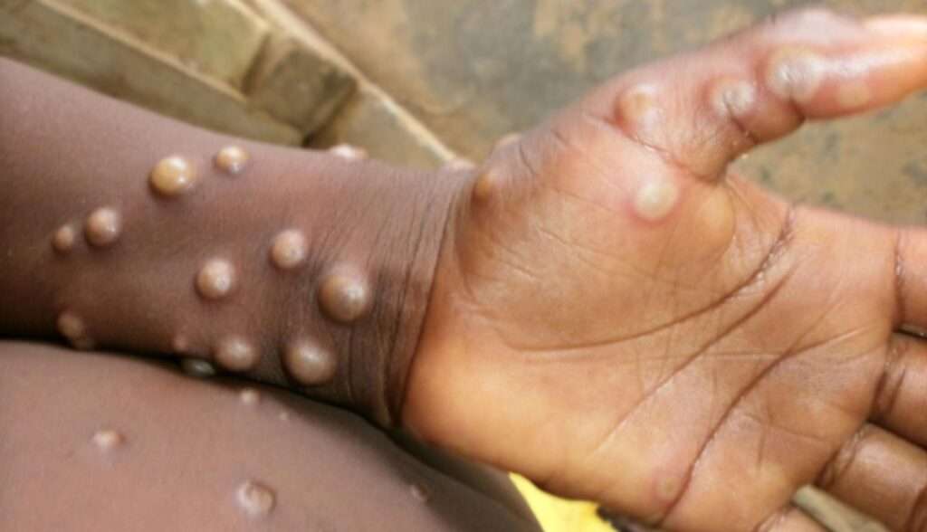 Monkey Pox Infection: Expert Calls For Scale Up In Surveillance To Detect Cases 2 Monkeypox