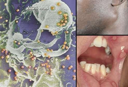 Historic as HIV Cure Finally Gets Tested On Humans 2 HIVAIDS