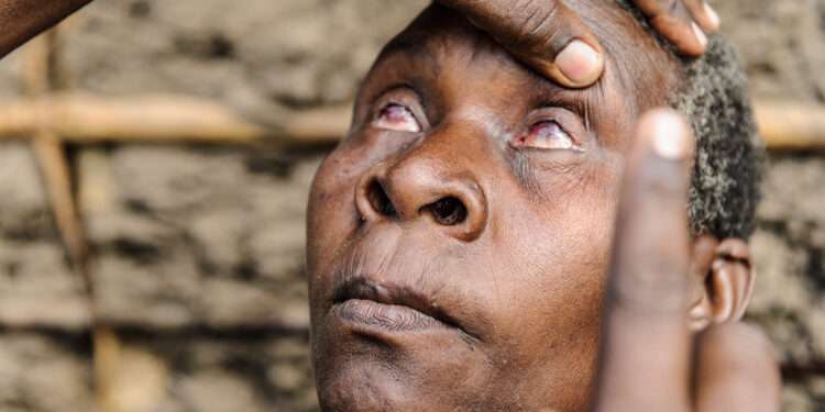 WHO Validates Malawi For Eliminating Trachoma, First Country In Southern Africa 1 WHO Validates Malawi For Eliminating Trachoma, First Country In Southern Africa