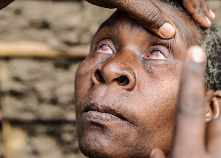 WHO Validates Malawi For Eliminating Trachoma, First Country In Southern Africa 1 WHO Validates Malawi For Eliminating Trachoma, First Country In Southern Africa