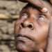 WHO Validates Malawi For Eliminating Trachoma, First Country In Southern Africa 11 WHO Validates Malawi For Eliminating Trachoma, First Country In Southern Africa