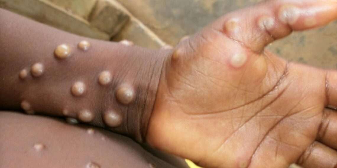 <strong>World Health Organization Renames Monkeypox</strong> 1 Monkeypox