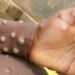 <strong>World Health Organization Renames Monkeypox</strong> 11 Monkeypox