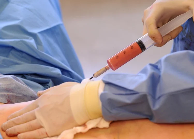 The BBL Craze To Enhance Looks 1 BBL Surgery Procedure