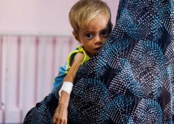 A child receives treatment for malnutrition at the Nasser Hospital in Khan Younis, in the southern Gaza Strip.
