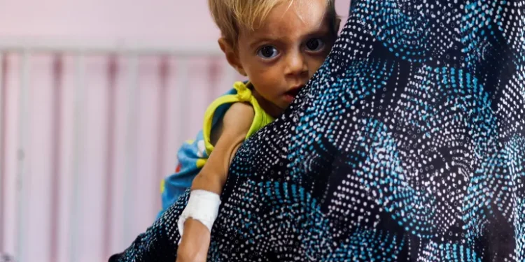 Israel’s Starvation Campaign In Gaza Yields “Results” 1 A child receives treatment for malnutrition at the Nasser Hospital in Khan Younis, in the southern Gaza Strip.
