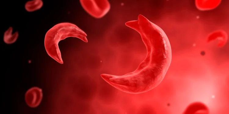 Government Commits to Eradicating Sickle Cell Disease 1 Sickle Cell Disease