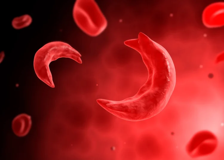 Sickle Cell Disease