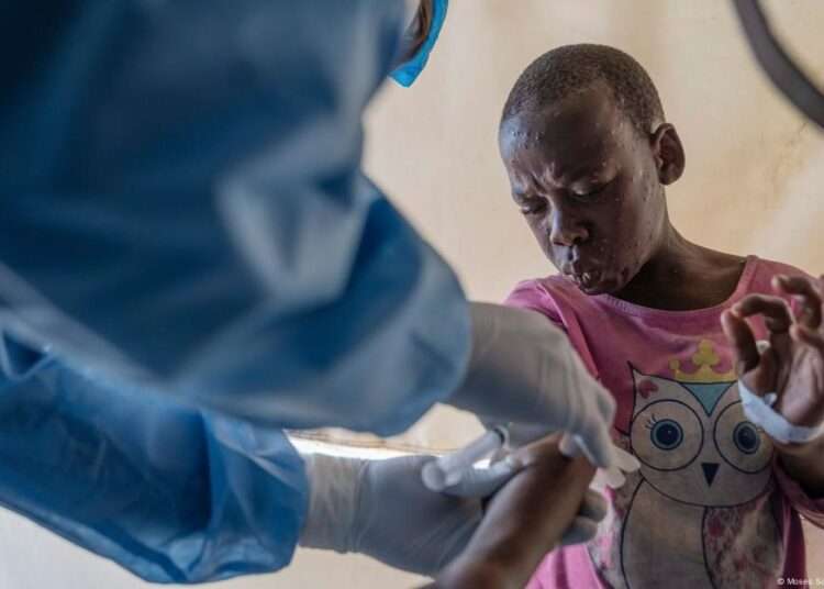 Senegal Confirms First Mpox Case Of 2025