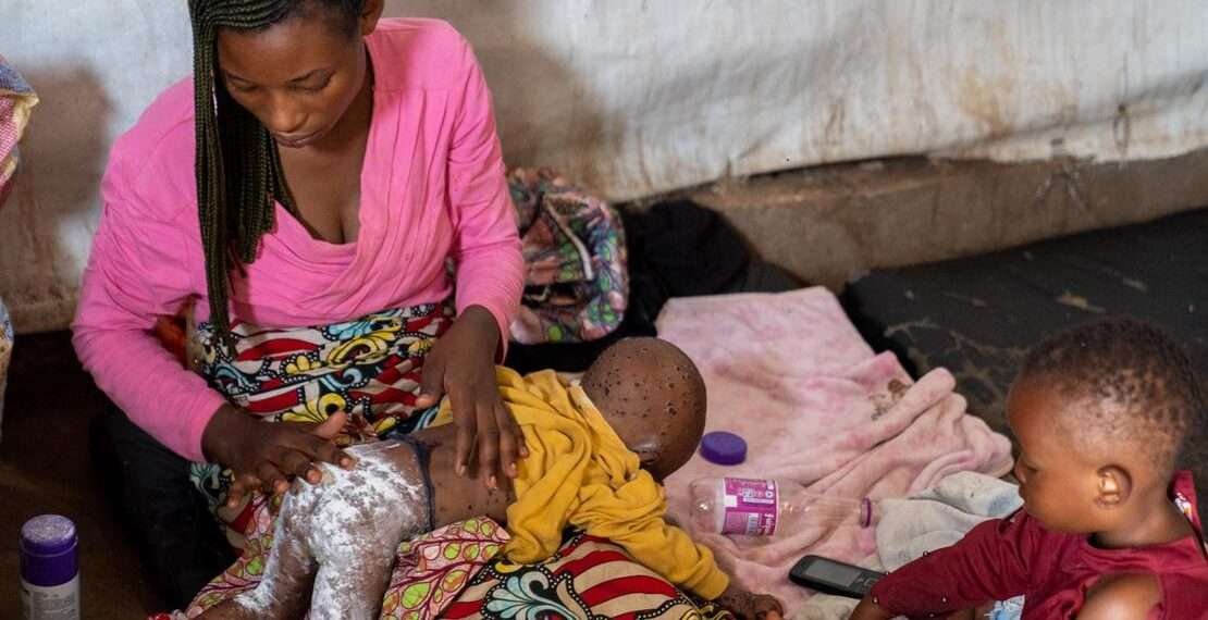 South Kivu has reported more than 800 cases of mpox, with many children affected