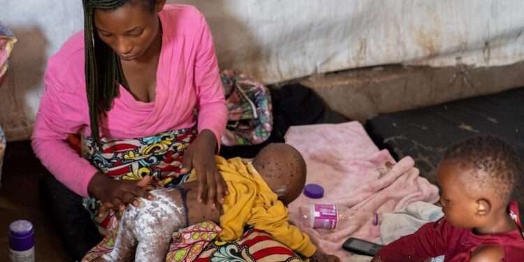 South Kivu has reported more than 800 cases of mpox, with many children affected