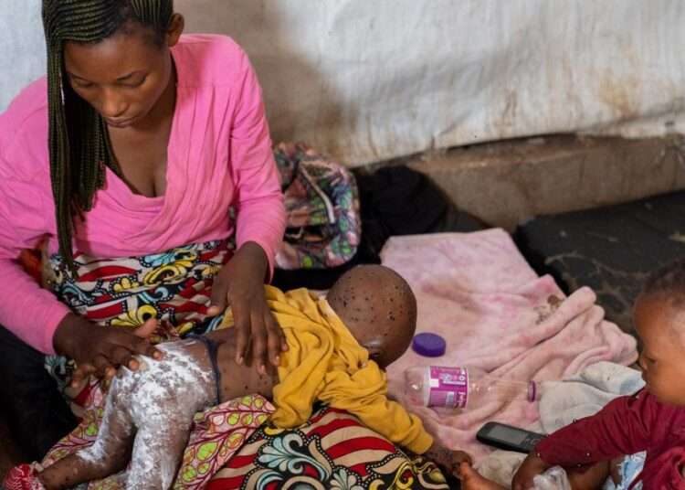 Congo's Fight Against Mpox, Children Hit Hardest 1 South Kivu has reported more than 800 cases of mpox, with many children affected