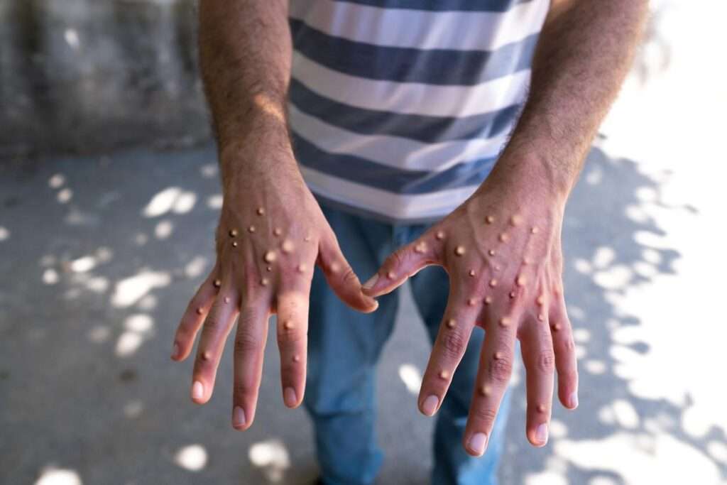 Mpox on back of hands