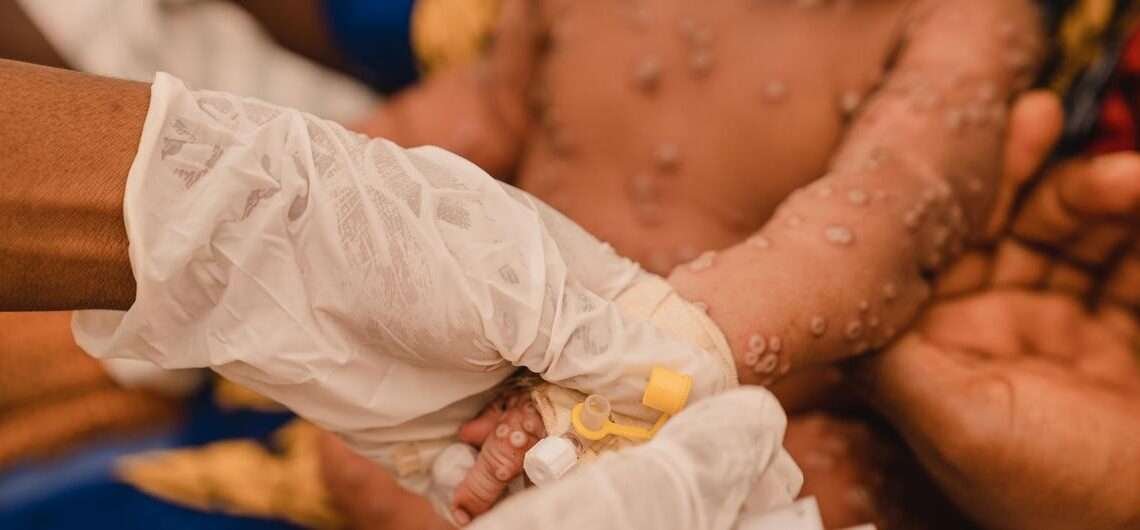 UNHCR Appeals for $21 Million to Fight Mpox Outbreak 1 A one-month-old child receives treatment at the mpox isolation unit of the UNICEF-supported Kamanyola Hospital in South Kivu province, DR Congo.