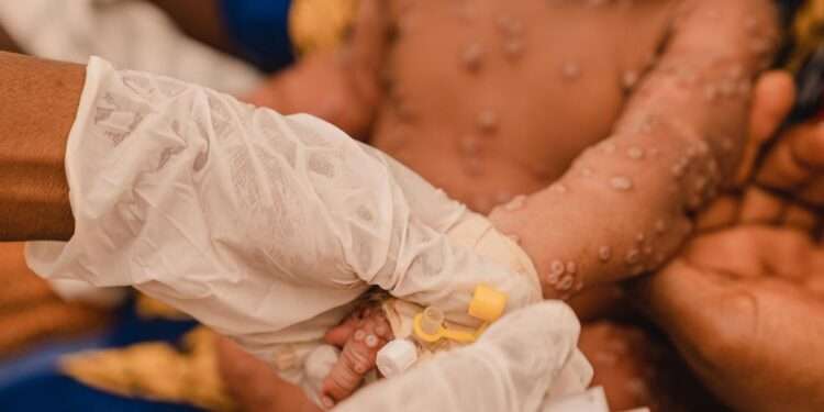UNHCR Appeals for $21 Million to Fight Mpox Outbreak 1 A one-month-old child receives treatment at the mpox isolation unit of the UNICEF-supported Kamanyola Hospital in South Kivu province, DR Congo.