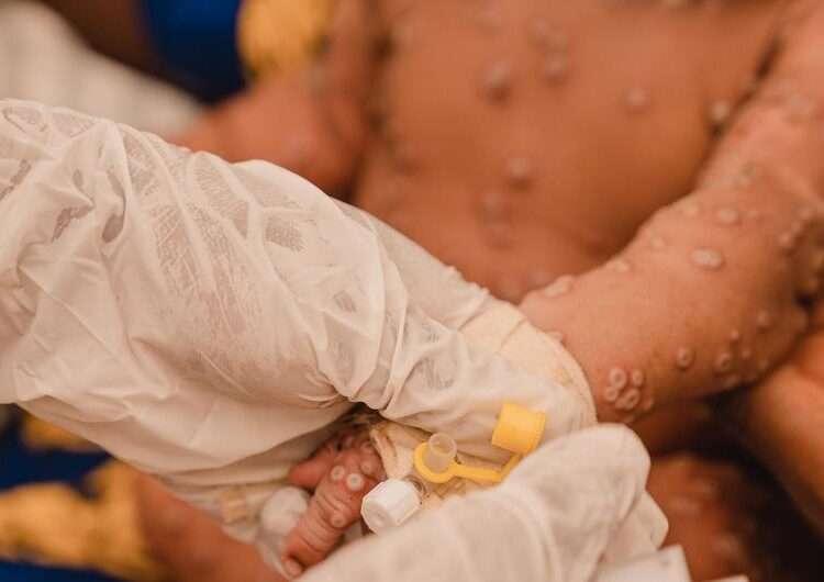 UNHCR Appeals for $21 Million to Fight Mpox Outbreak 1 A one-month-old child receives treatment at the mpox isolation unit of the UNICEF-supported Kamanyola Hospital in South Kivu province, DR Congo.