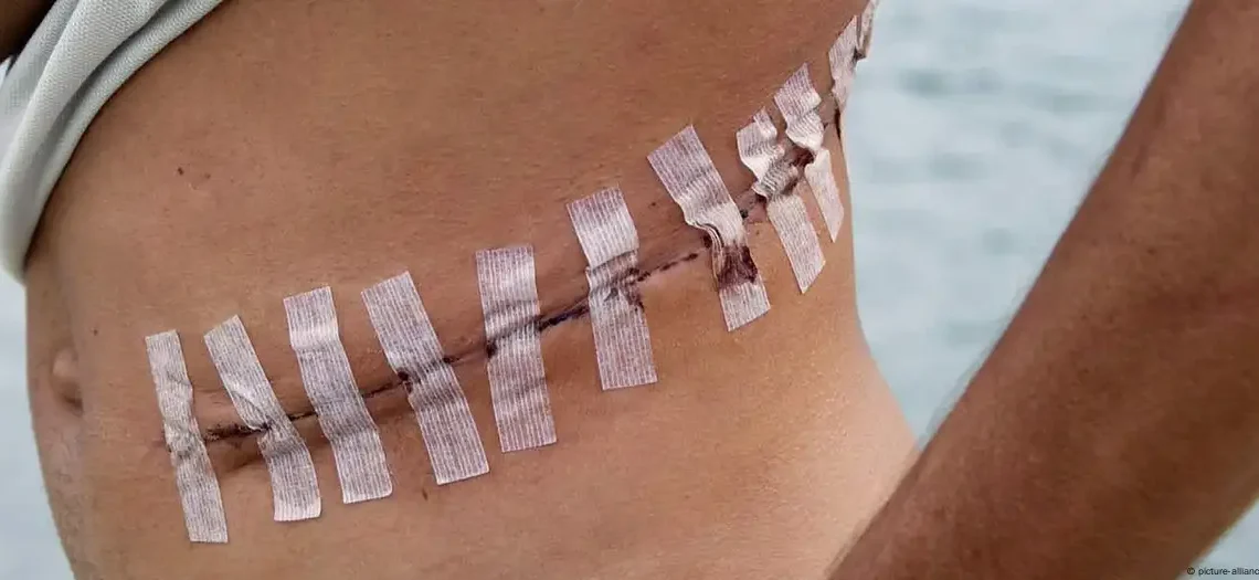Illegal Organ Trade in Africa Soars to Epidemic Levels 1 An unidentified Brazilian man shows the scar after an operation to remove his kidney in Durban, South Africa, in 2023