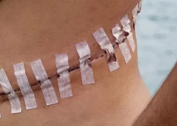 An unidentified Brazilian man shows the scar after an operation to remove his kidney in Durban, South Africa, in 2023