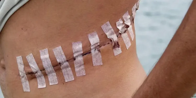 Illegal Organ Trade in Africa Soars to Epidemic Levels 1 An unidentified Brazilian man shows the scar after an operation to remove his kidney in Durban, South Africa, in 2023