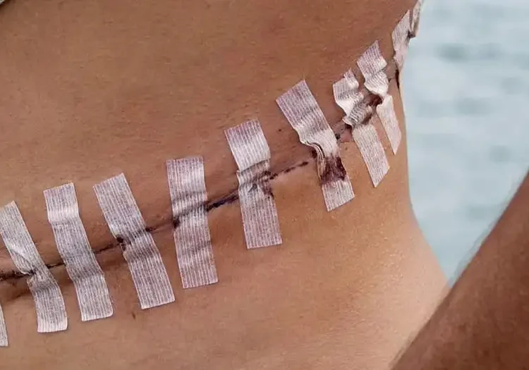Illegal Organ Trade in Africa Soars to Epidemic Levels 1 An unidentified Brazilian man shows the scar after an operation to remove his kidney in Durban, South Africa, in 2023