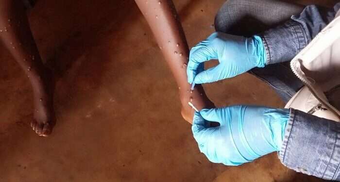 Alinity m MPXV assay