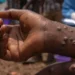 Mpox Symptoms
