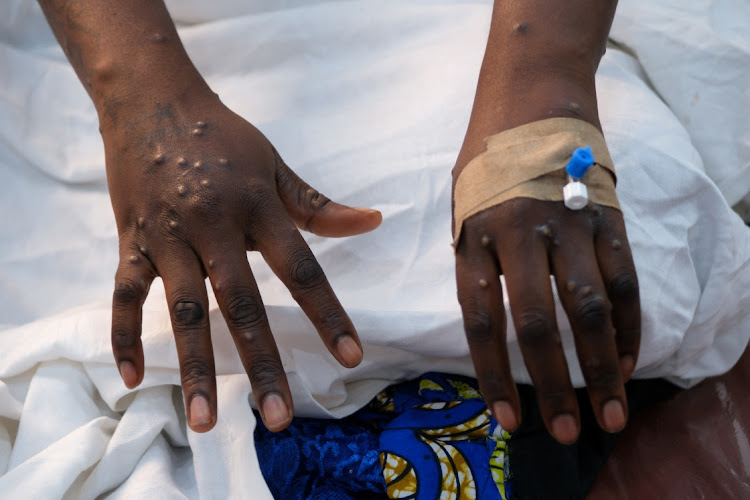 Ghana Confirms Two Mpox Cases, Moves Swiftly to Contain Spread 2 Mpox 2