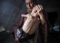 Muhammad Zakariya Ayyoub al-Matouq, an 18-month-old child in Gaza City, Gaza, faces life-threatening malnutrition.