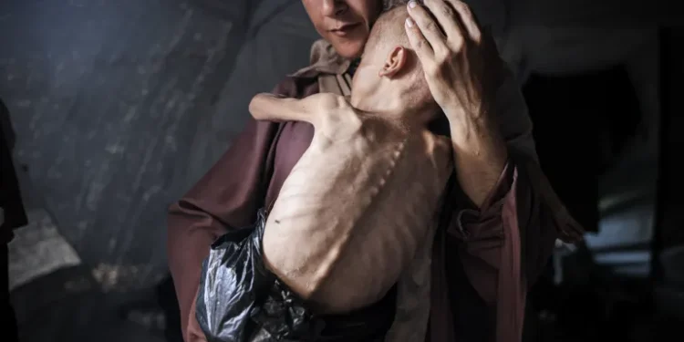 Muhammad Zakariya Ayyoub al-Matouq, an 18-month-old child in Gaza City, Gaza, faces life-threatening malnutrition.