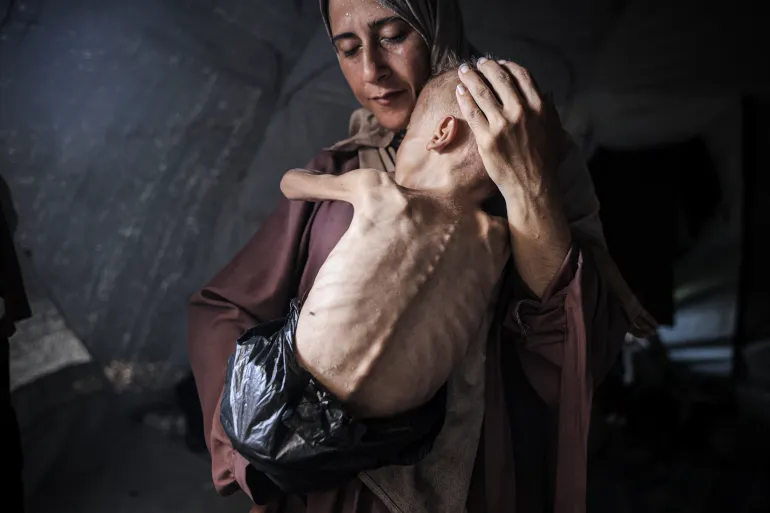 AA 20250722 38624940 38624931 MALNOURISHED TODDLER IN GAZA FIGHTS FOR LIFE AMID ONGOING ISRAELI ATTACKS 1753173066 89df6b 1753266198
