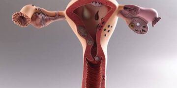 PCOS