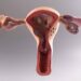 Early PCOS Diagnosis Can Reduce Health Risks for Women - Dr. Eugene 11 PCOS
