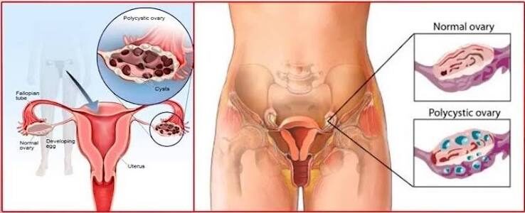 Early PCOS Diagnosis Can Reduce Health Risks for Women - Dr. Eugene 3 image 105 7