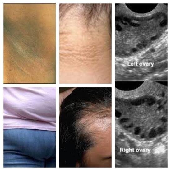 Early PCOS Diagnosis Can Reduce Health Risks for Women - Dr. Eugene 4 image 105 9