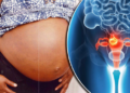 Fibroid in Women