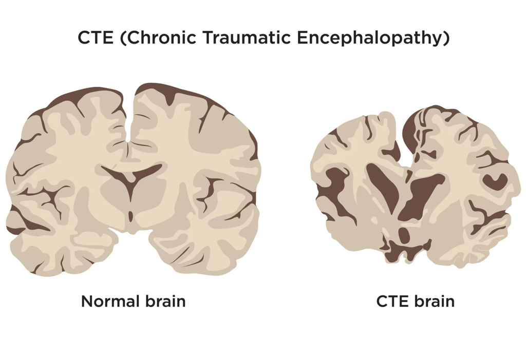 CTE Affects Nearly a Quarter of Former NFL Players, Study Reveals 3 image 227