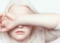 UN Expert Warns Colour Discrimination Harms Persons with Albinism 7 Person with Albinism