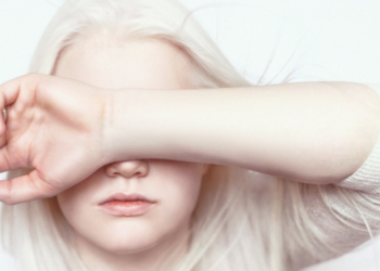 UN Expert Warns Colour Discrimination Harms Persons with Albinism 2 Person with Albinism