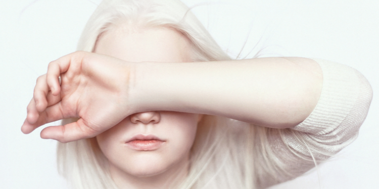 UN Expert Warns Colour Discrimination Harms Persons with Albinism 1 Person with Albinism