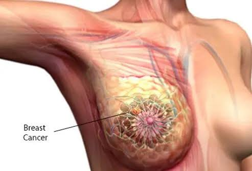 Gilead Medical Director Warns Late Breast Cancer Diagnosis Reduces Survival 2 image 523